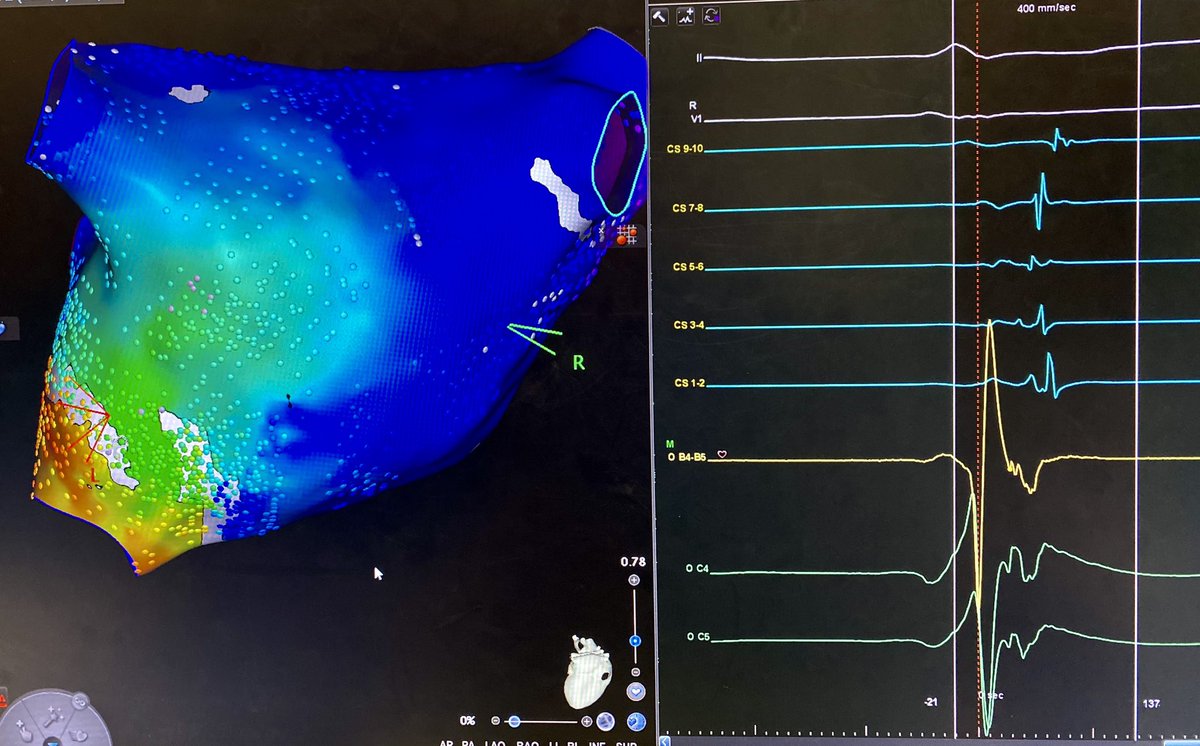 Accessory pathway annotation as LAT - Medial to lateral oblique course of a left posterolateral accessory pathway during RV pacing (as predicted by Jackman).<a href="/rdangeloMD/">Robert D'Angelo</a> <a href="/RonukModi/">Ronuk Modi, MD</a> <a href="/carto_Carli/">Carli Carbone</a>