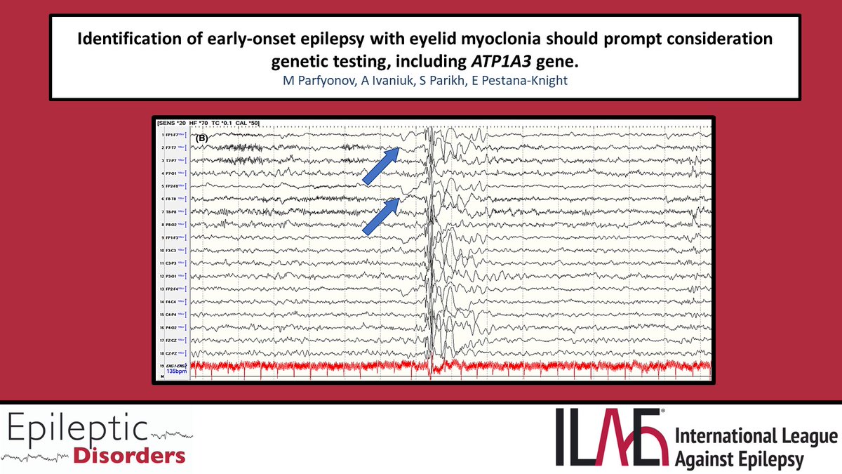 EpiDisorders's tweet photo. (1/2) @MParfyonov et al. report a 2 yo F with early-onset epilepsy with eyelid myoclonia/EEM who was found to have a pathogenic variant in ATP1A3 gene. @RoohiKatyal @fabnascimen @SBeniczky @WileyNeuro @WileyHealth @Ilaeweb

https://t.co/BR6sTYfNSr https://t.co/uBdPfMrqXG