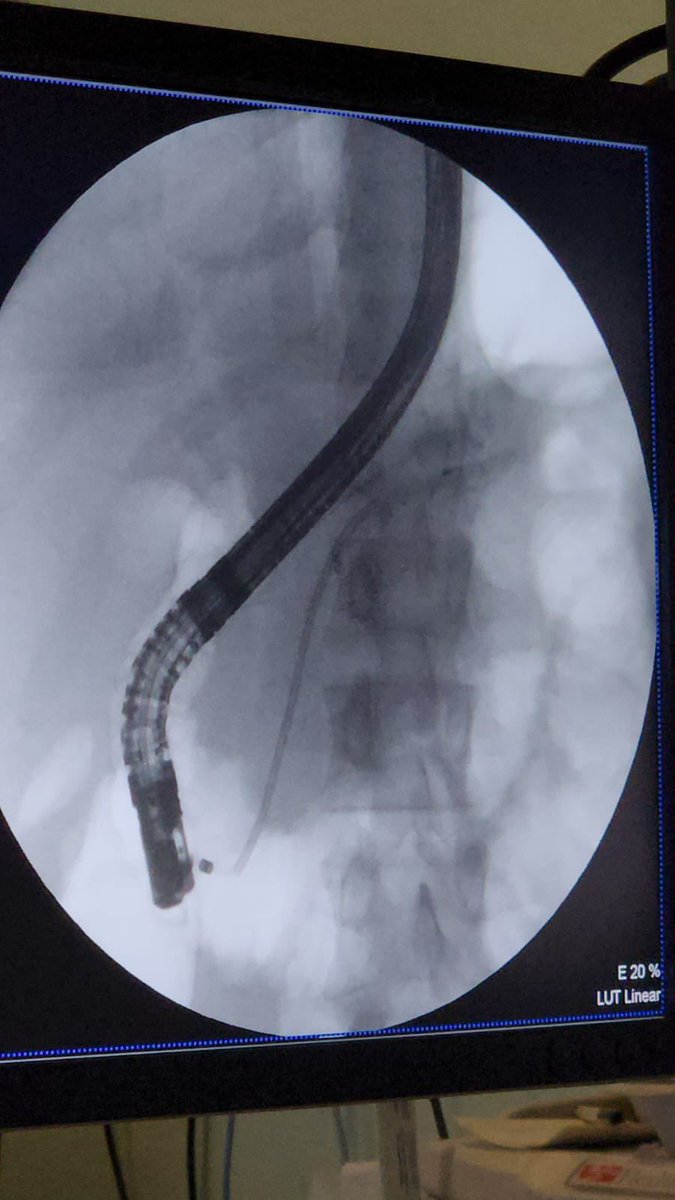 DrAmmarAlotaibi's tweet photo. Patient with chronic Pancreatitis &amp; MPD 🪨 + abdominal pain 

ERP + 🕵️‍♂️ >>>>> ⚡️⚡️⚡️ but very hard🪨🪨🪨 !!!

Stone is half size now, stent in with plan to repeat after few weeks of plastic stents! 

Love tough #ERCP !! https://t.co/vwP0a2nozK