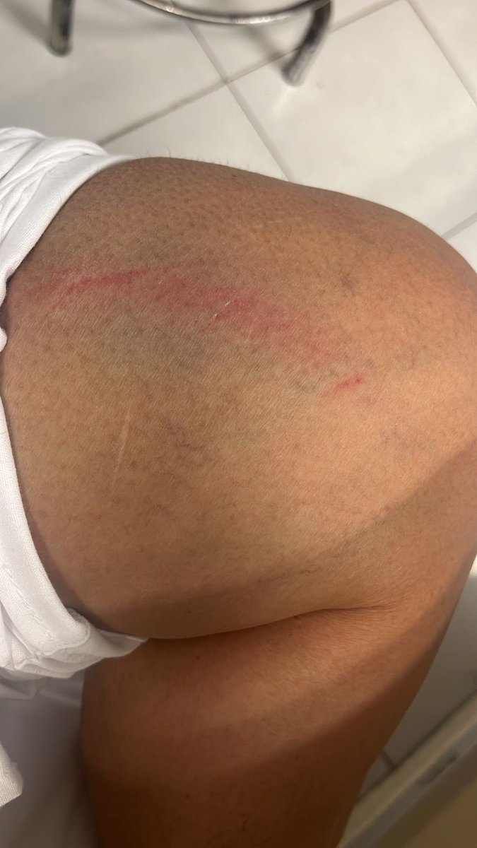 LauraBruges's tweet photo. 🤕Me informan algunas de las mujeres   médicos, que fueron golpeadas por elementos de la @SSC_CDMX

Se manifestaron pacíficamente en el centro de la CDMX debido a la incertidumbre laboral en su paso al IMSS-Bienestar. @IMSSBIENESTAR (Llevan meses buscando un acuerdo y manifestándose) 

Los siguen amenazando con aceptar el nuevo sistema de contratación. 

¿Así golpean a quienes entregaron su vida y esfuerzo en la pandemia 😷@martibatres @OHarfuch ?