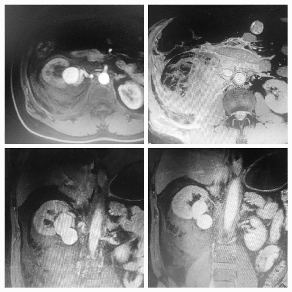 Dr Saurabh kumar Interventional radiologist tweet media