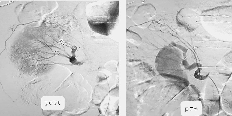 Dr Saurabh kumar Interventional radiologist tweet media