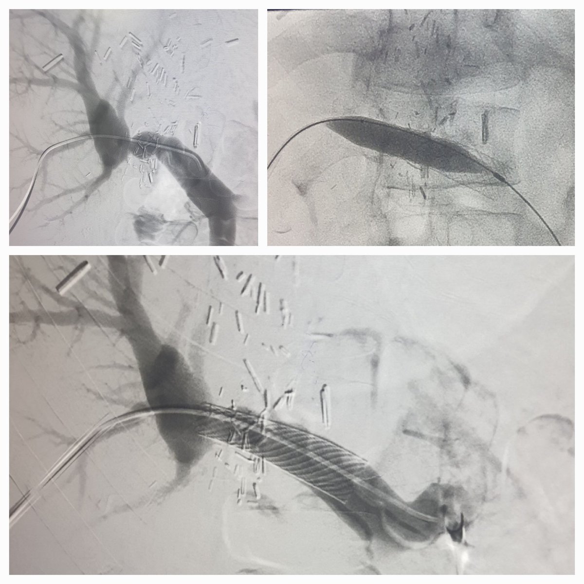 Dr Saurabh kumar Interventional radiologist tweet media