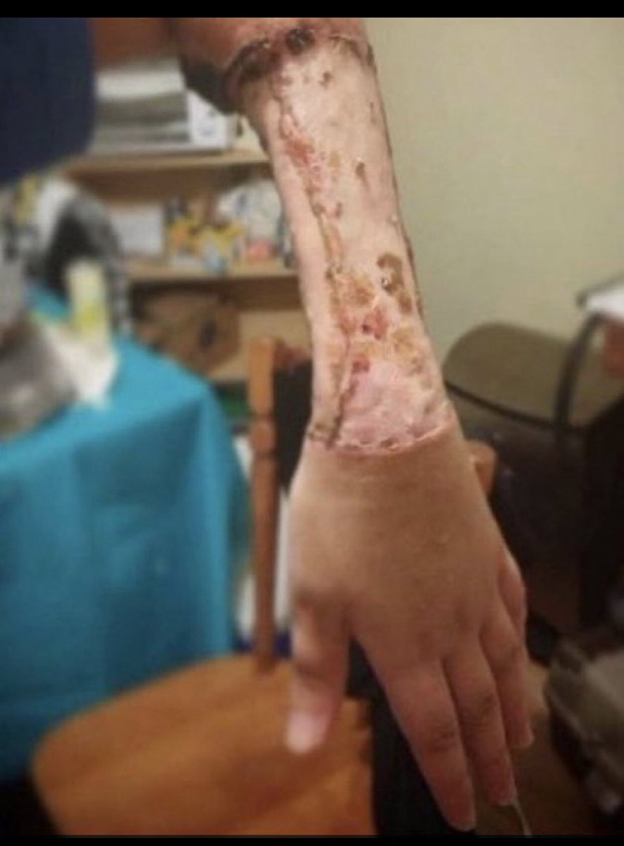 This is what Nazi doctors are doing to young people to get rich. This is how Nazis create a fake penis for unstable young people. This is what DemNazi call health care. This person will probably face infections for the rest of their lives.