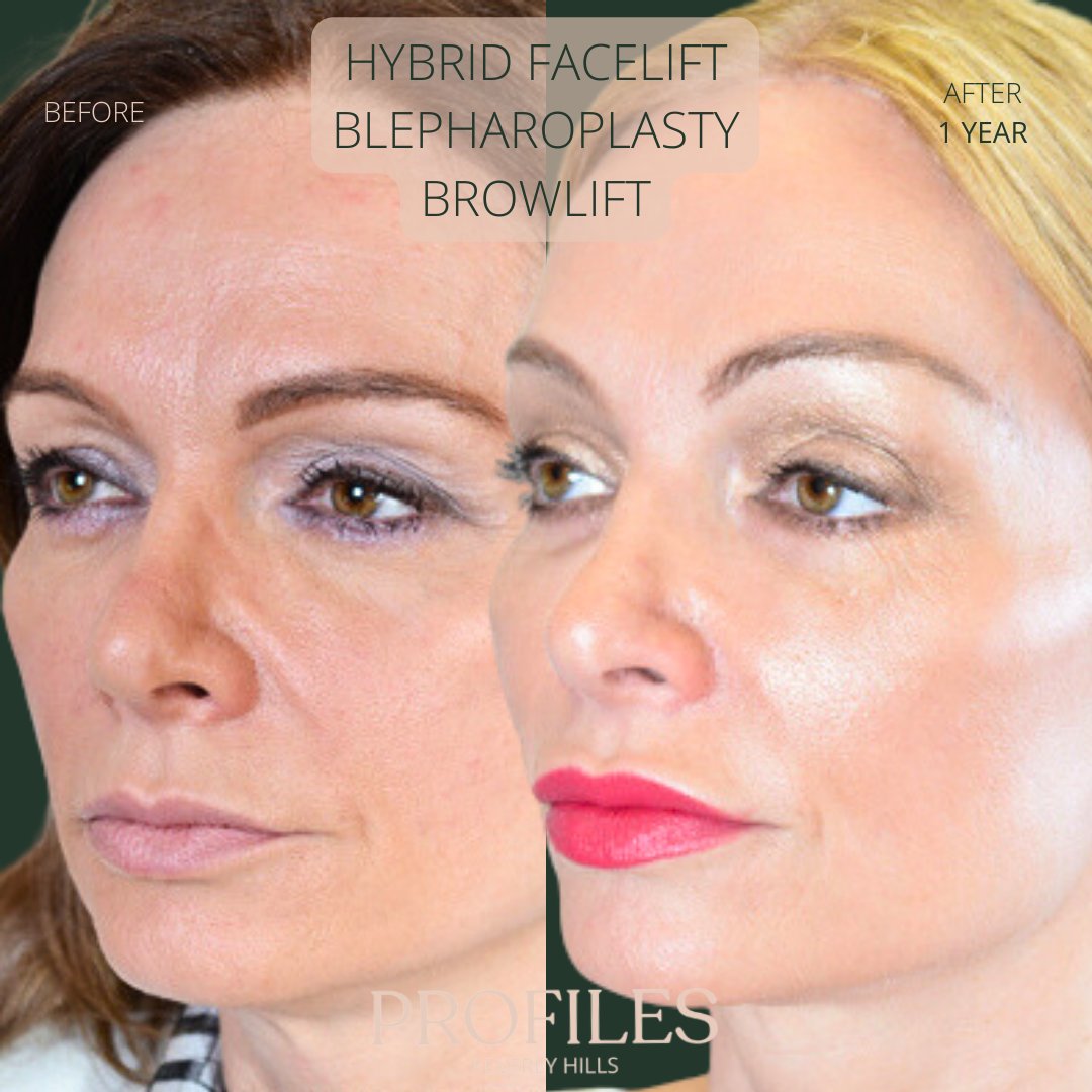 FacialPlastics's tweet photo. 📞310-276-6800​​​​​​​​​🏠 435 N Bedford Drive, PH500, Beverly Hills, 90210
👱‍♀️Hybrid Facelift, Blepharoplasty, Browlift
🗓 Before and After 1 Year
🛏 About 1 week, the cast gets taken off after 6 days

Swipe ⏩⏩⏩ for more views

Are you looking for a facial rejuvenation that can https://t.co/TOEo7h0vvl