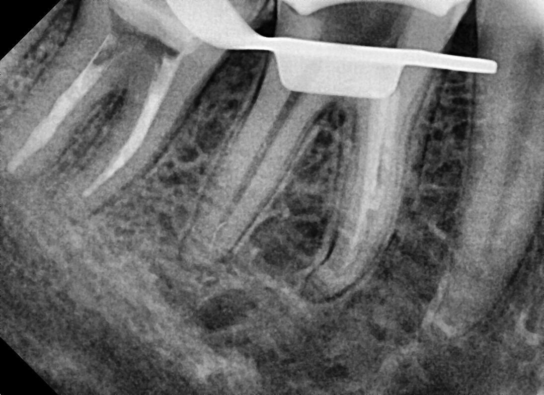 ahmedabuhadi's tweet photo. #46 
Old defect restoration and recurrent Caries 
Pulp Dx AIP/NAT
During a negotiation the Canals , rotary file broke in DB canal File retrieved by helping with @Dr_abubakr1 nice anatomy
Then obturation done 
NV Fiber post and prep for crown 

ENDO RESTO JOURNEY❤️ https://t.co/FgFbWlcdAv
