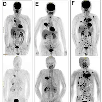AuntMinnie's tweet photo. FAPI-PET shows promise for diagnosing lung cancer #radiology https://t.co/uOcQ7EoZ3D https://t.co/IurpW5WL6V