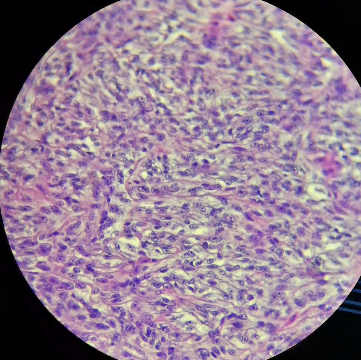 Clear cell sarcoma
34yo male, with lesion on the heel
S100 and HMB45 positive
#pathology #anapath #softtissue