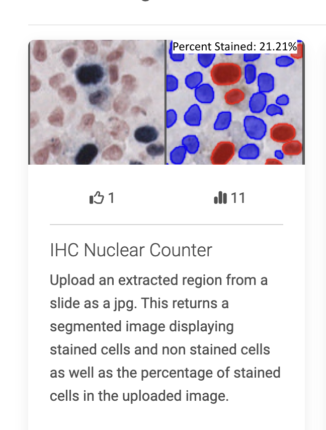 pdiamandisii's tweet photo. Check out the #AI #deeplearning powered Immunohistochemistry Nuclei Counting App now on CODIDO (https://t.co/tVaGhofU82). Simply upload an extracted image from a #digitalpathology slide and get a objective quantification of positive nuclei. #pathology #pathtwitter #neuropath https://t.co/brf3pfcRux