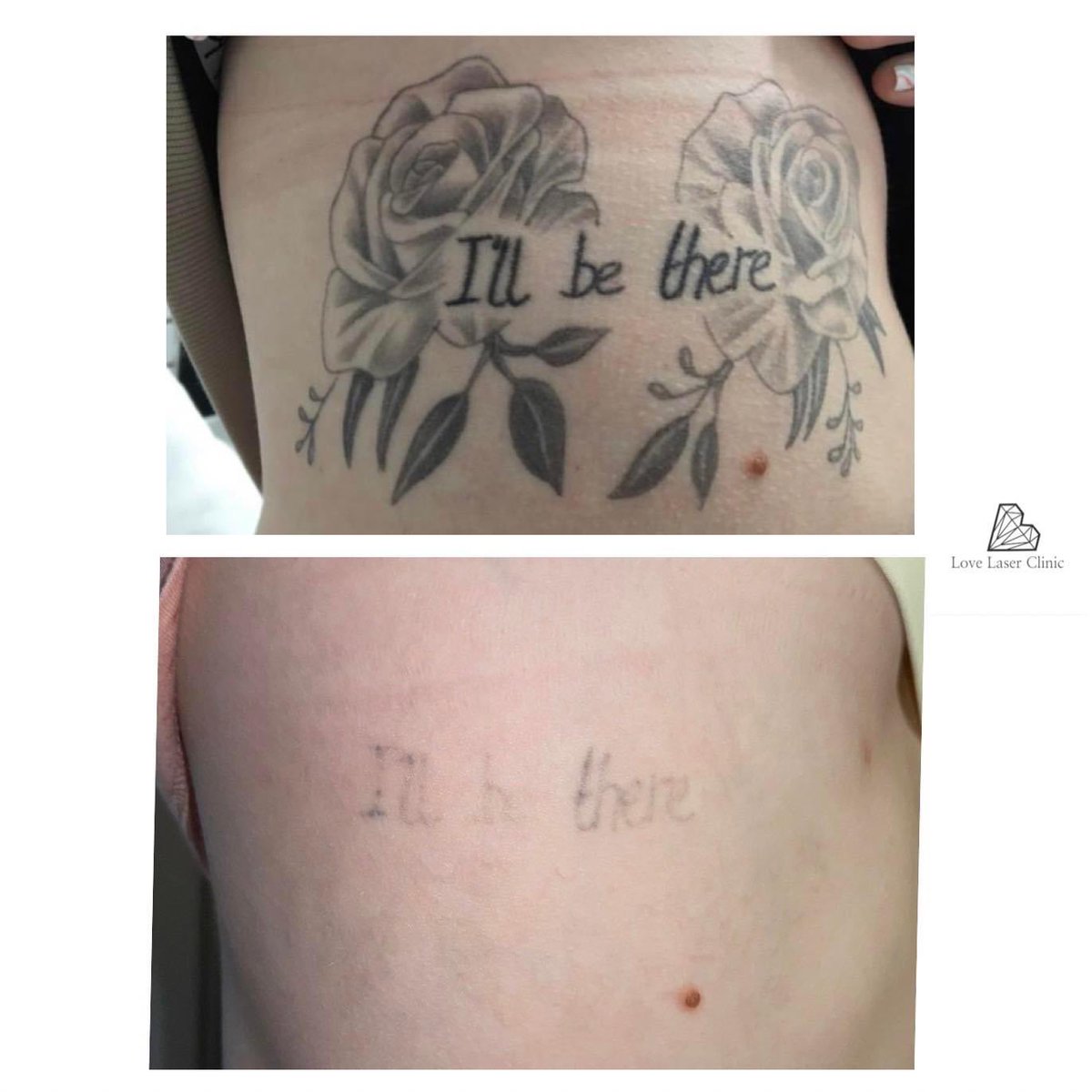 Six sessions of laser tattoo removal, has almost eradicated this black tummy tattoo
 🙌 

#tattoos #beforeandafter #lasertattooremoval #tattooremoval #unwantedink #nottingham #aftercare #lovelaserclinic