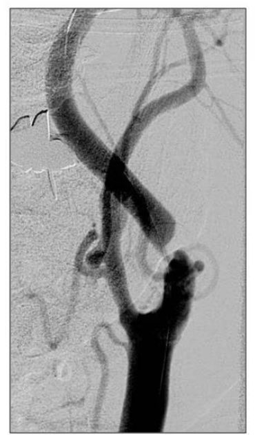 Hady Lichaa, MD, FACC, FSCAI, FSVM, RPVI (@hadylichaamd) on Twitter photo Please submit your comments to #CMS regarding #CarotidArteryStenting coverage today. Deadline approaching.
cms.gov/medicare-cover…
<a href="/SCAI/">SCAI</a> <a href="/chadialraies/">Chadi Alraies, MD FACC FSCAI</a> <a href="/andresvargasECU/">AV</a> <a href="/haseebqazi/">Haseeb Qazi</a> <a href="/jaygirimd/">Jay Giri</a> <a href="/DrDrewKleinPHI/">Drew Klein</a> <a href="/vikasaggarwalmd/">Vikas Aggarwal</a> <a href="/jcgeorgemd/">Jon George</a> <a href="/JVargheseMD/">Joji Varghese</a> <a href="/EricSecemskyMD/">Eric Secemsky MD MSc</a> <a href="/Stent4U/">Chris White</a> Please submit your comments to #CMS regarding #CarotidArteryStenting coverage today. Deadline approaching.
cms.gov/medicare-cover…
<a href="/SCAI/">SCAI</a> <a href="/chadialraies/">Chadi Alraies, MD FACC FSCAI</a> <a href="/andresvargasECU/">AV</a> <a href="/haseebqazi/">Haseeb Qazi</a> <a href="/jaygirimd/">Jay Giri</a> <a href="/DrDrewKleinPHI/">Drew Klein</a> <a href="/vikasaggarwalmd/">Vikas Aggarwal</a> <a href="/jcgeorgemd/">Jon George</a> <a href="/JVargheseMD/">Joji Varghese</a> <a href="/EricSecemskyMD/">Eric Secemsky MD MSc</a> <a href="/Stent4U/">Chris White</a>