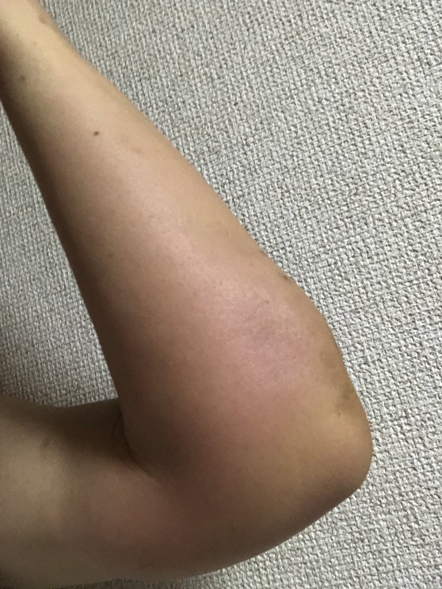 awarecircle's tweet photo. 転んで���がパンパン！
骨折してる？かもねー汗💦
でも、治すのは自分の免疫力しかないので、５日間くらい、ビックリする程眠れた！身体が修復したがってる❣️
免疫力万歳🙌笑笑
#自己免疫アップ重要 https://t.co/gTwD1V2vv7