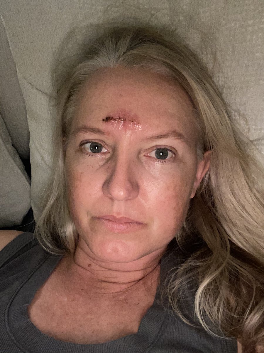 Also, an update: I went in for my dermatologist appt like a month ago now and they biopsied a spot on my forehead. Turned out to be basal cell carcinoma, so they had to remove it and I got stitches. Just a PSA go to those appts. #basalcellcarcinoma
 #skincancer #dermatologist