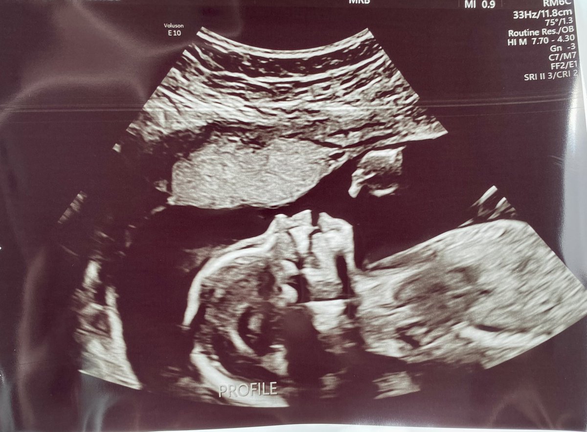 Secrets out, baby girl Stork is arriving this Christmas ☺️💕✨