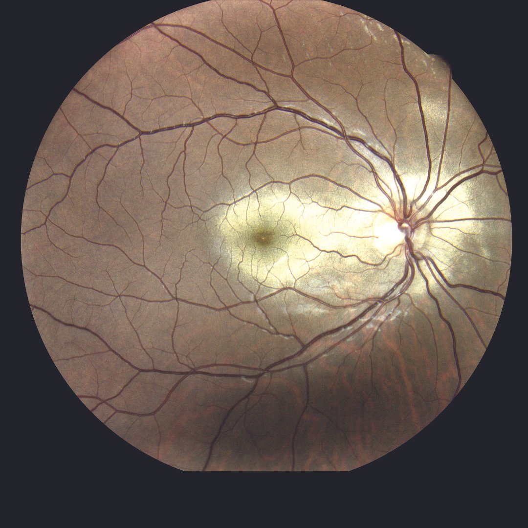 RetinaOfTexas's tweet photo. Our August Image of the Month features Commotio Retinae.
#commotioretinae #retina #retinaspecialist #RetinaConsultantsofTexas #RCTX #PreservingYourVisionIsOurMission https://t.co/Rm28qcKMhg