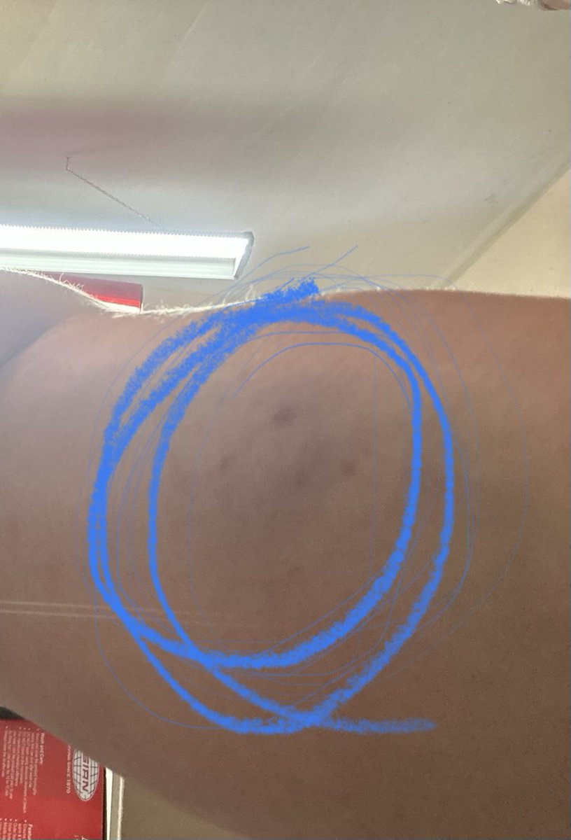_sushiee's tweet photo. Family camp was a success and had a wonderful time. This past weeknd was much needed!! Ps this bruise came from them kids throwing water balloons, they jumped me lol https://t.co/PpX8HjukWs