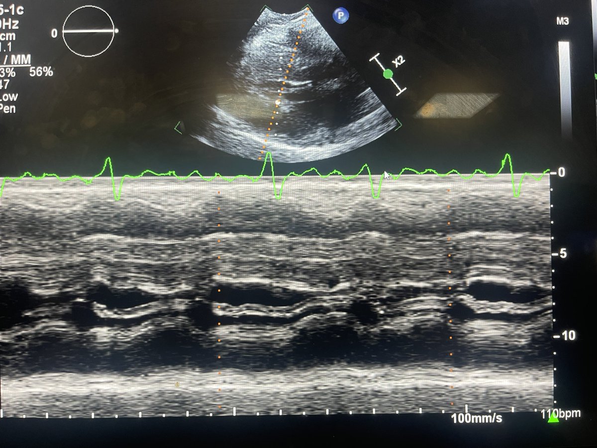 bbumc92's tweet photo. Systolic anterior motion on M mode in HOCM. Images from fellowship. #echofirst #CardioTwitter https://t.co/rOthzmuvHU