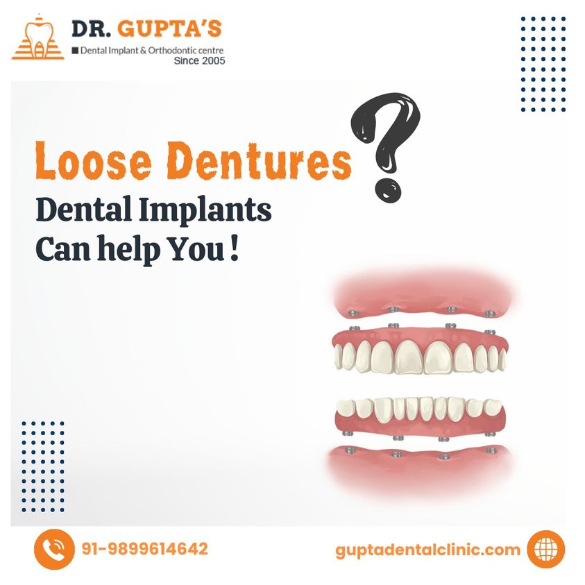 guptadentals's tweet image. Loose Dentures?
Dental Implants can help you!
Call to book an appointment for a Confident &amp;amp; Beautiful Smile.
📲 at 9899614642
or
visit guptadentalclinic.com for more details.
.
.
#dentalimplants #DentalImplantSurgery #LooseDentures #teethproblem #smiledesigning #smilemakeover