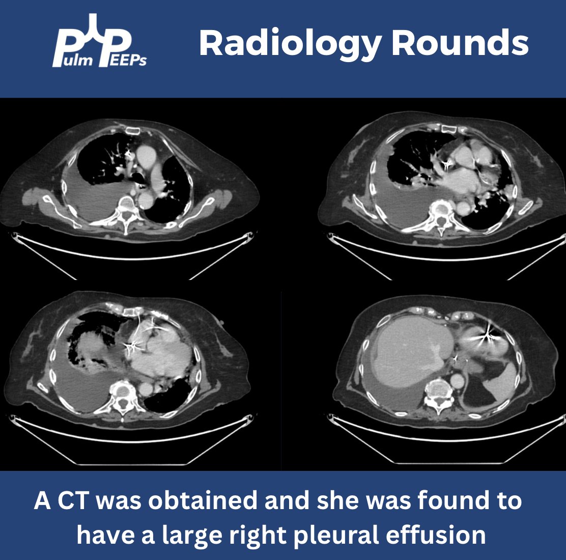 🫁We are back with another #RadiologyRounds🫁

We have an older-aged woman found to have gastric and duodenal ulcers requiring multiple abdominal surgeries and transhepatic biliary drainage presenting with respiratory distress .