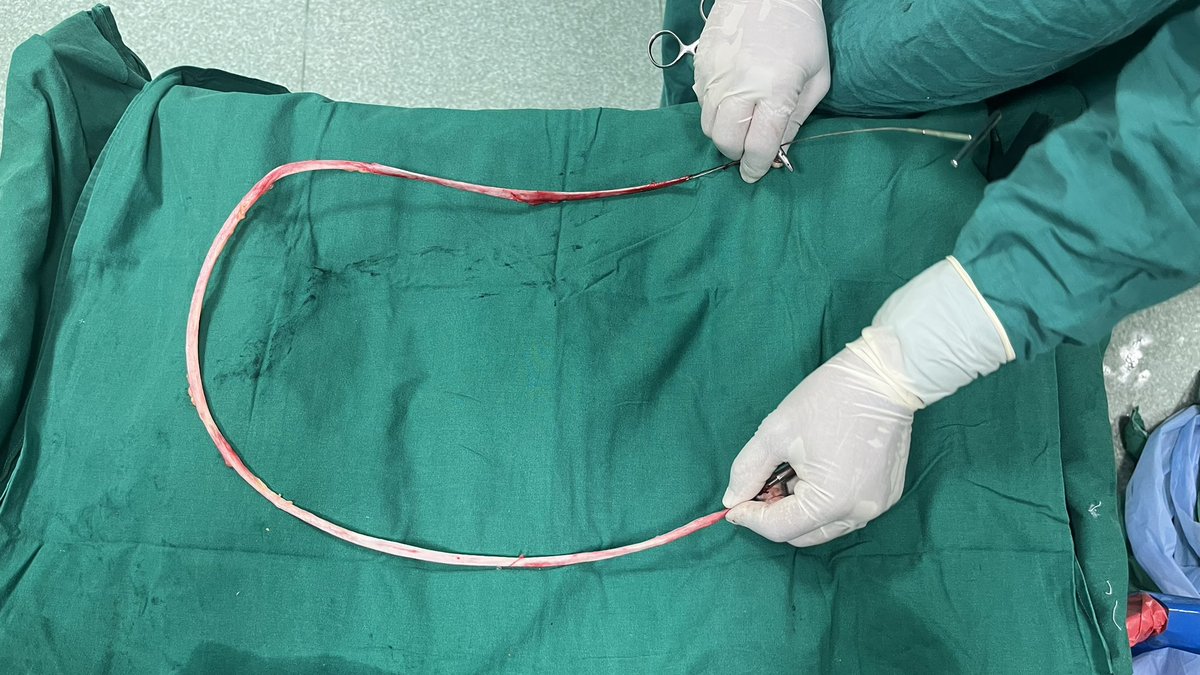 parthgada's tweet photo. The entire length of the great saphenous vein
GSV ligation + stripping 
#MedTwitter #surgery #varicose https://t.co/mcmRgIUdnO