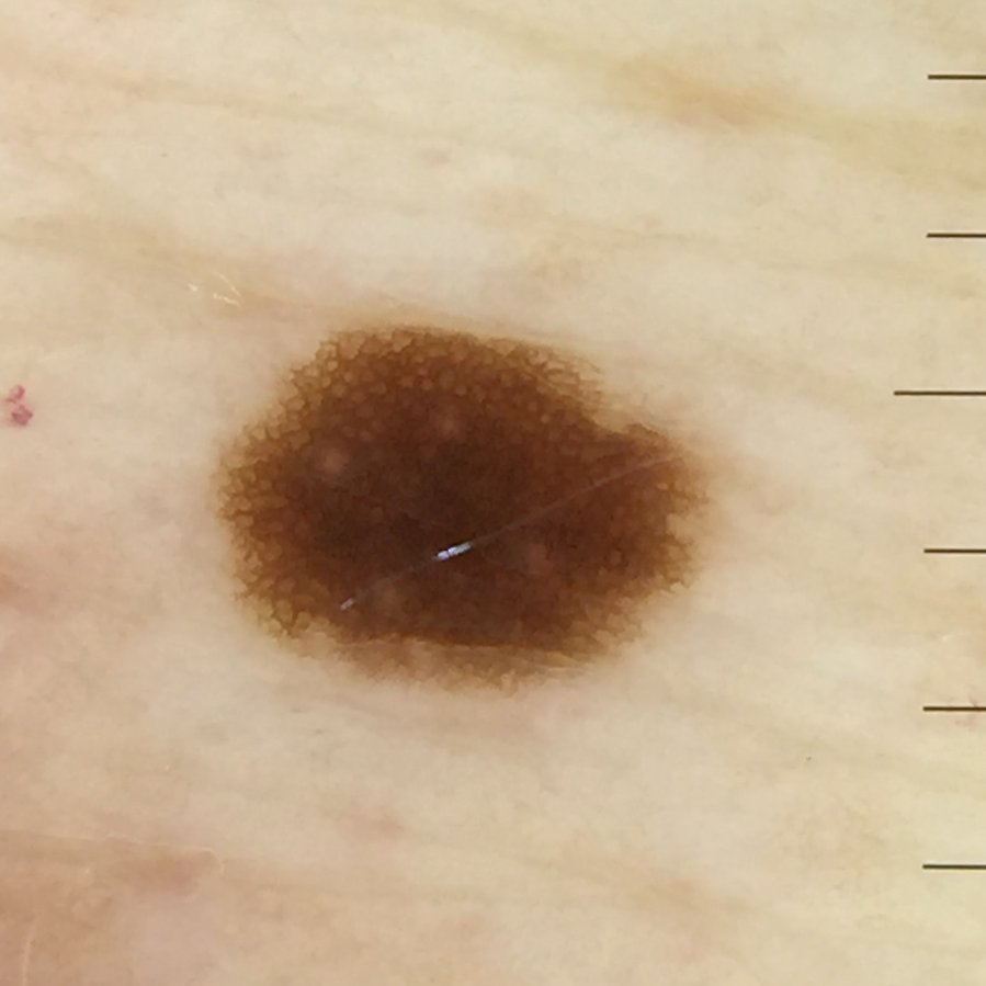 hauterer69's tweet photo. #DermatoskopieQuiz für zwischendurch:
Meine neuer Assistenzarzt für Dermatologie hat mir eine OP eingetragen, er operiert selber noch nicht. Dieses Mal ist ihm in der Sprechstunde aufgefallen.  "Der Patient hat viele Nävi, aber das hier ist bei Weitem das dunkelste". 
Stimmt. https://t.co/HjvosomKsP