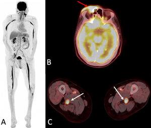 Esta comunicación breve de la Revista Radiología expone la presentación de un linfoma como neurolinfomatosis de los nervios ciático y mediano

¡No te lo pierdas! 🔗 bit.ly/45cmiUi
