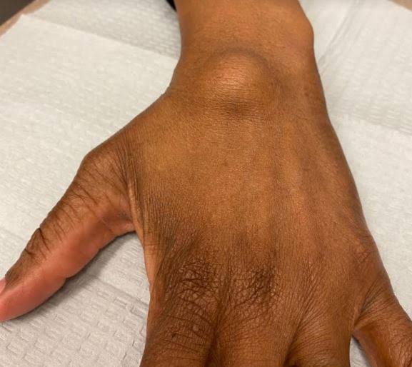 the_beardedsina's tweet photo. Question of the Day

She noticed this on her hand. It disappeared before and came back, and is still there

What is this?
What causes it?
Is it dangerous? https://t.co/0SGDJLQlKo