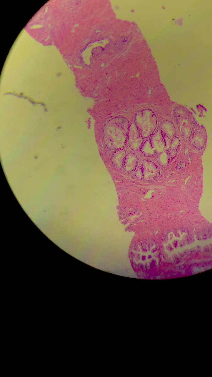 DrKumarVicky's tweet image. Can anyone name the structures in this microscopic section of prostate sample?

🔬Prostate Biopsy

#TwitterPath