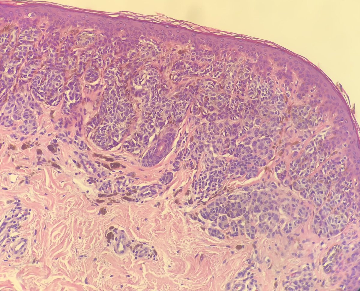 gemamoreno91's tweet photo. Lesión pigmentada en abdomen.
Resección.
Proliferación de melanocitos a nivel de la unión dermoepidérmica y en dermis superficial, con displasia moderada y fibrosis.
No se identifica extensión pagetoide ni mitosis.
Dx: nevus displásico compuesto
#dermatopath https://t.co/8W1bJj9Zkl