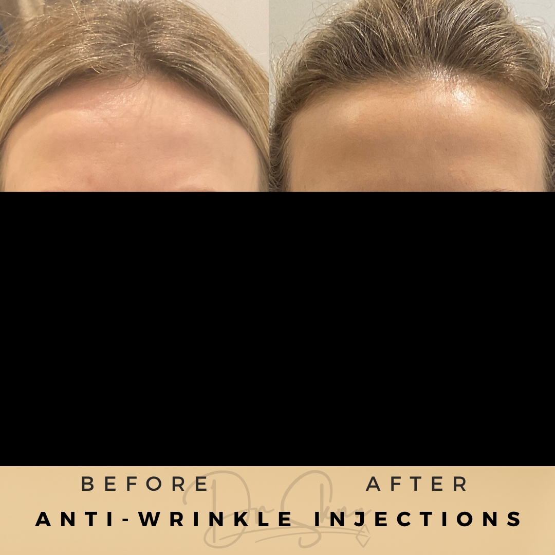 Turn Back the Clock: Botox for Forehead Wrinkles at Dr. Sknn Wilmslow Aesthetics Clinic

#botoxfacial #antiwrinkle #injectables #antiageing #wrinkles #injections #botoxinjection #cheshireaesthetics #wrinklefree #foreheadwrinkles #drsknn