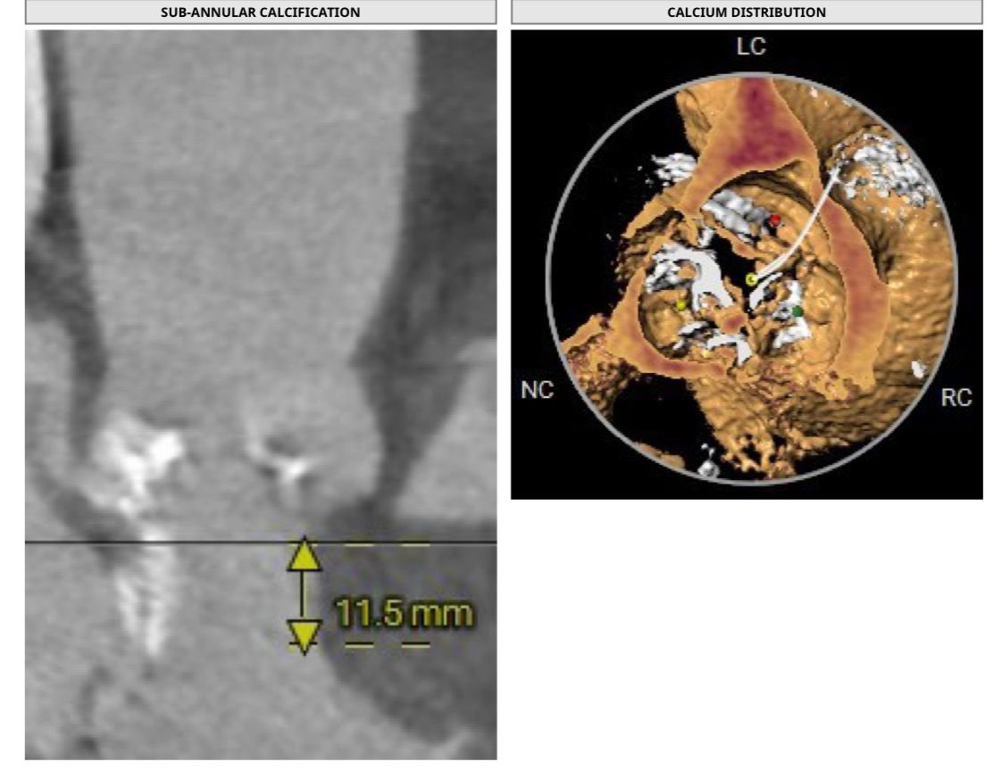 MosaAbbadi1's tweet photo. 85 y♂️with severe AS TYPE II BAV with Sub-annular calcification, TAVI done using Evolut FX 26 mm for the first time “Stable and predictable deployment”
Excellent final results #commisural_alignment #cusp_overlap
No PVL or ECG ↔️,MPG6 https://t.co/zIGxJevGJr