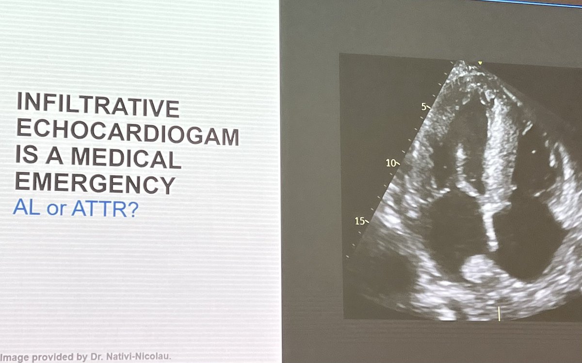 The one and only Dr. Jose Nativi-Nicolau gives amazing #amyloid lecture @MayoClinic FL IM Grand Rounds 📌 Echocardiographers: TTE suspicious for infiltrative process? —>alert ordering provider-it’s a critical result! 📌Screen for carpal tunnel and lumbar stenosis in all HFpEF pts