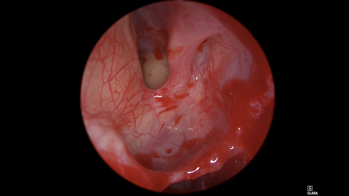 DrScottFortune's tweet photo. #Draf2A is limit of my extended approaches to #FrontalSinus, picture quality decreases w some "red out" but can see the opening of #AggerNasi identifying #SupraorbitalEthmoidCell then removing rest of cells along lamina to enter the Frontal #posteriortable visible on 4 #rhinology https://t.co/NHGCCzOsgH