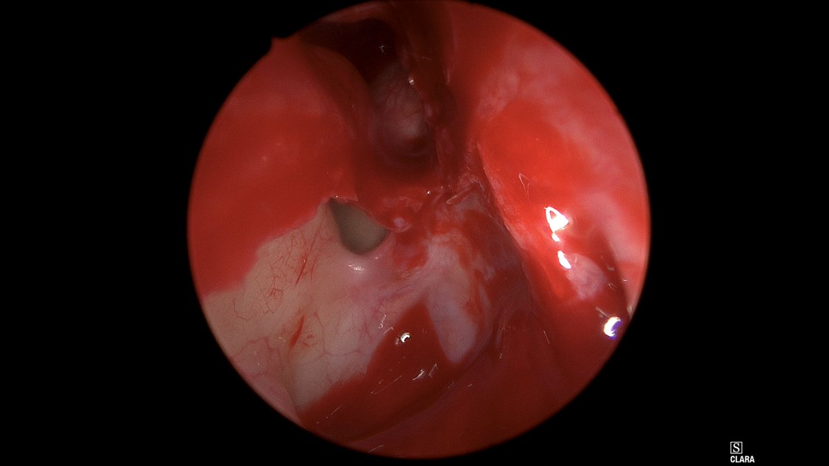 DrScottFortune's tweet photo. #Draf2A is limit of my extended approaches to #FrontalSinus, picture quality decreases w some "red out" but can see the opening of #AggerNasi identifying #SupraorbitalEthmoidCell then removing rest of cells along lamina to enter the Frontal #posteriortable visible on 4 #rhinology https://t.co/NHGCCzOsgH