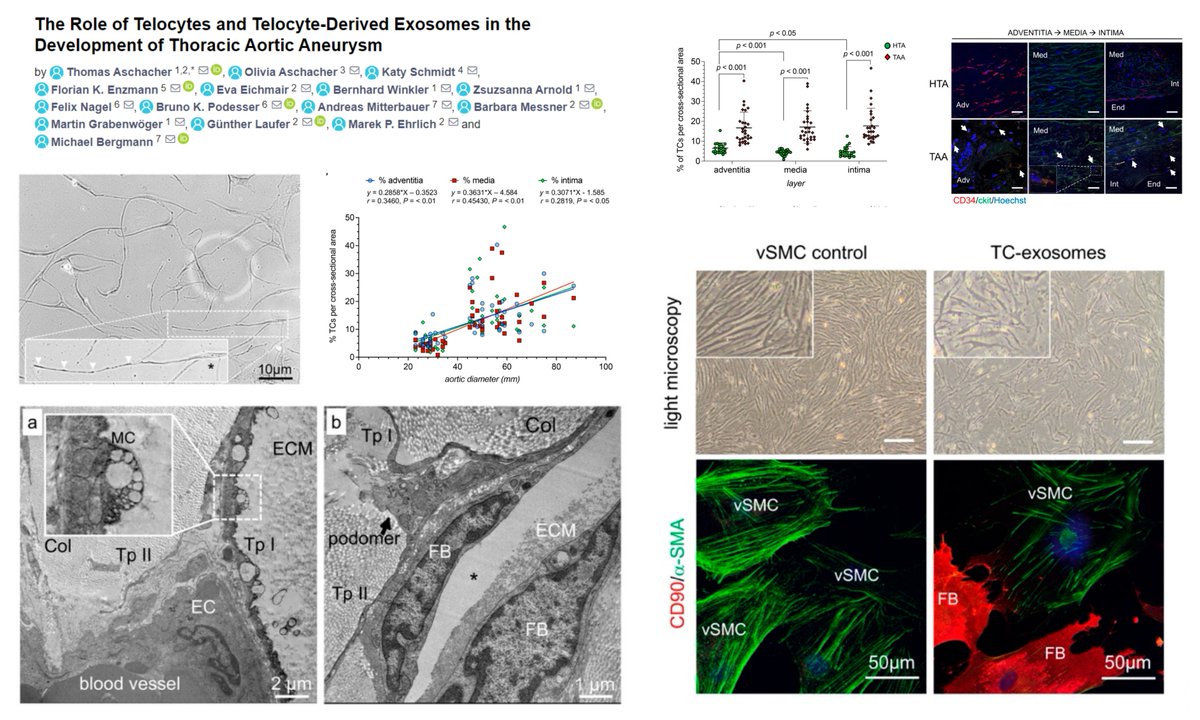 HaoYin20's tweet photo. CD34+cKit+ACTA2+CNN1+CD133- aortic #Telocyte exist across intima-media-adventitia in👤Aorta

⏫in #ThoracicAorticAneurysm

Telocyte-derived #Exosome promotes #SmoothMuscleCell synthetic phenotype in culture

@AschacherMd @IJMS_MDPI 2022
https://t.co/M2rhBH5vJ5 https://t.co/mSYwD2ShLh
