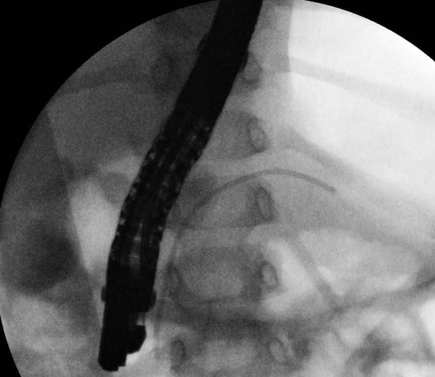 David Vitale MD (@davidvitalemd) on Twitter photo #ERCP in 3yo (15kg) with PRSS1 and 5 episodes of AP in 6 months with significant pancreatic duct stricture. Even young children get PD misery! #gitwitter <a href="/ASGEendoscopy/">ASGE GI Endoscopy</a> #ERCP in 3yo (15kg) with PRSS1 and 5 episodes of AP in 6 months with significant pancreatic duct stricture. Even young children get PD misery! #gitwitter <a href="/ASGEendoscopy/">ASGE GI Endoscopy</a>