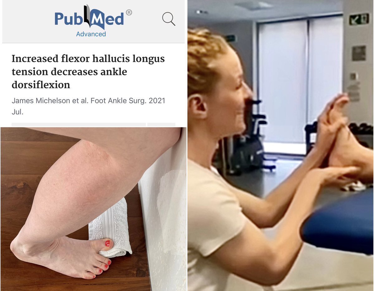 lizbayleyphysio's tweet image. FHL &amp;amp; ankle DF 🦶🏼
Mini thread 🧵

🔹 FHL tightness was found in almost half of 188 Pts - it’s more common than previously recognised
🔹Ankle DF ⬇️ as FHL tension ⬆️ in ‘normal’ and symptomatic Pts
🔹A tight FHL can be linked to hallux rigidus/dorsal osteophytes

1/5