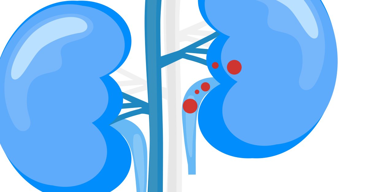 Can kidney stones be prevented? Jeffrey Glaser, MD, FACS, a Washington University urologist, answers this and other common questions about kidney stones in this week’s #AskTheBJCExpert.

ow.ly/iLRv50Pqewh