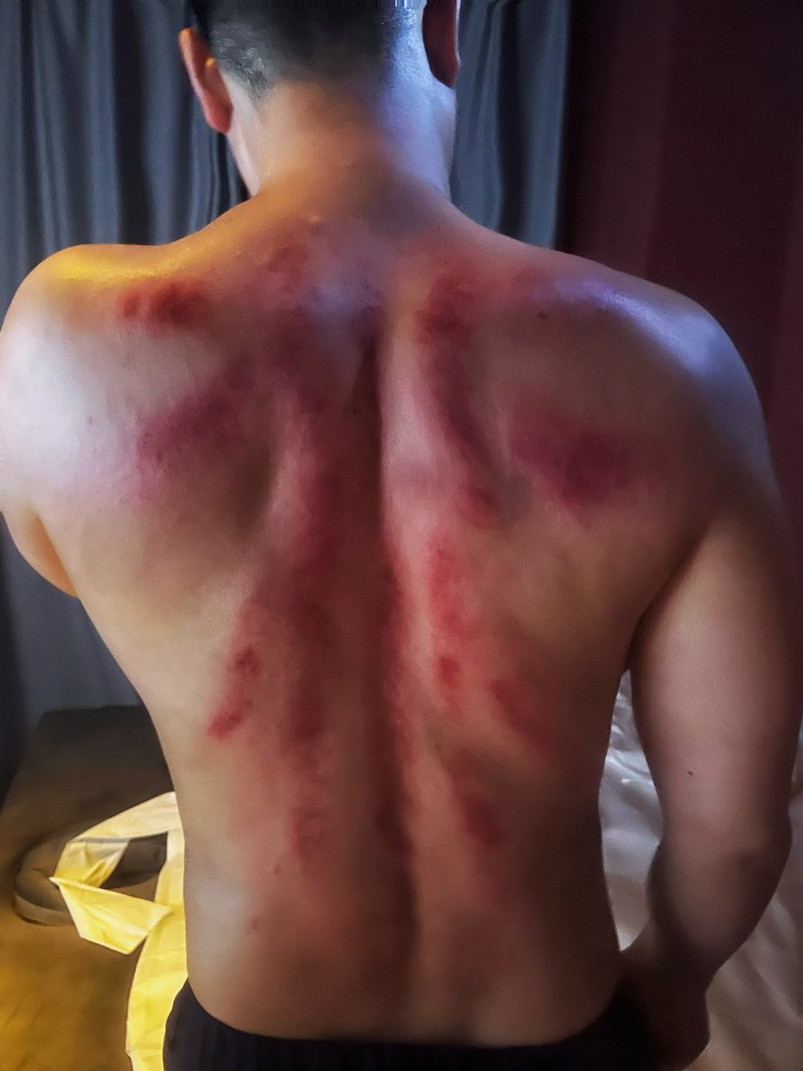 第一次刮痧，火辣辣的疼😭