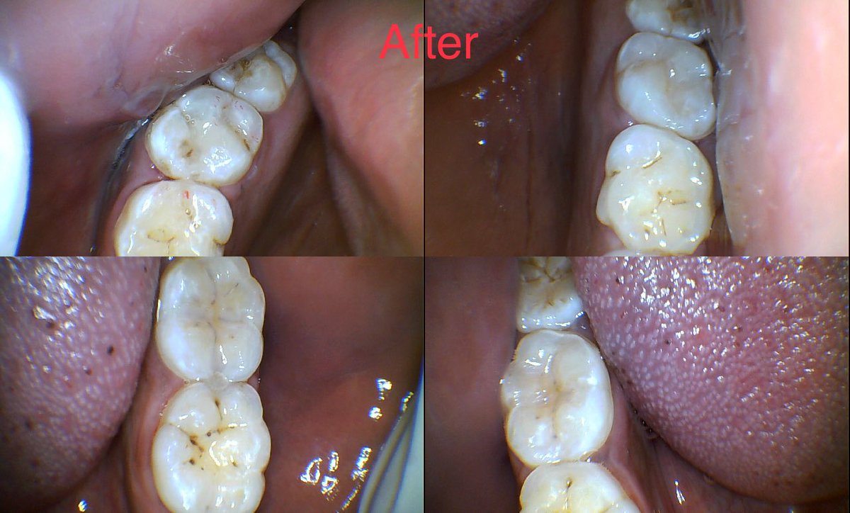 Branicemercy's tweet photo. Routine dental check ups ( atleast once a year ) could you save you a lot of money and pain here is why …. (Read to the end to save at least 150k for dental care 😊)

Our teeth have 3 layers enamel , dentine and pulp . Enamel is the outermost layer and does not contain any nerves when you have a cavity here you might not know as you don’t feel any pain or symptoms but your dentist might be able to pick them out on your annual check up like in frame 3 of 1 or on dental X-rays . At this point your dentist will advice on diet and oral hygiene practices and do a filling or a fissure sealant this cost average 6k for quality tooth colored fillings  💵 like the ones done below by your truly 😊

The second layer of the tooth is called dentine and contains nerve endings . If you delay for your visits the decay may reach the second layer . This may be painless at the beginning but as it moved closer to the 3 rd layer you might experience mild to severe sensitivity depending on how close it is to the pulp which is the 3 rd layer . in the earlier stages a filling may still be possible or temporary filling may be done to allow the tooth to heal followed by a permanent filling . At this point your cost of treatment may remain at 3-4 k for a temporary followed by the permanent after 6 to 8 weeks . So total cost of treatment at this stage about 5 to 10k 💵💵

The 3 rd layer of the tooth is called the pulp this is where all your never and blood vessels are housed . Any decay or irritant close to the pulp causes a lot of sensitivity and throbbing pain ( which could have totally avoided with a routine dental visit )  at this point the tooth may not respond to pain meds the treatment recommended is Root-canal treatment which just means disinfecting the inside of the tooth and completely sealing it from the Roots upwards . This will cost you about 15k done in one or more sessions . 💵💵💵

After Rootcanal treatment the tooth tends to be very brittle as most teeth are usually very damaged so it’s advisable you follow up with a crown to protect the tooth in the long term . A good quality crown will cost you between 20 to 35 k💵💵💵💵

Extraction is the very last resort for grossly damaged teeth  . While extraction on its own may not be expensive the permanent replacement may cost you kashamba somewhere . On average a dental implant will cost you about 150k 💵💵💵💵💵💵💵💵

So in a nutshell visiting your dentist regularly will help keep you on top of your game and take care of small things before they get out of hand . 

I hope this saves you some money and importantly pain .  Remember sharing is caring 🙏

As alway yours toothfully 
#BraniceyourTLdentist 🙏