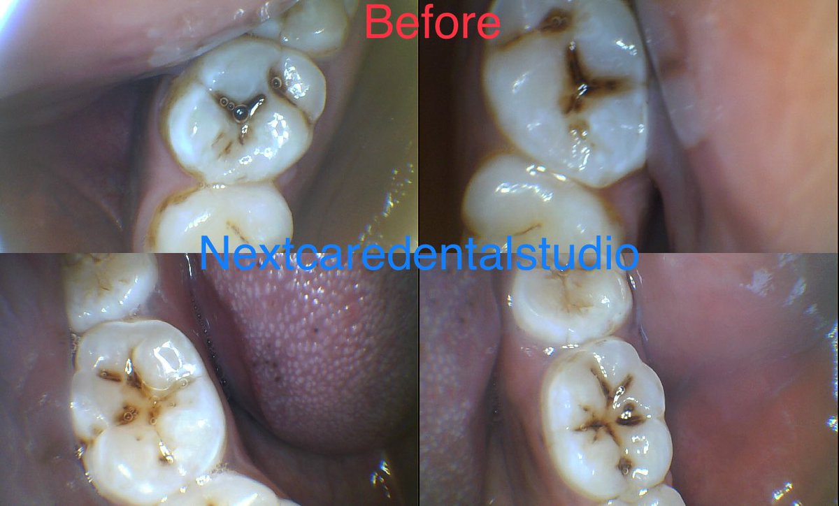 Branicemercy's tweet photo. Routine dental check ups ( atleast once a year ) could you save you a lot of money and pain here is why …. (Read to the end to save at least 150k for dental care 😊)

Our teeth have 3 layers enamel , dentine and pulp . Enamel is the outermost layer and does not contain any nerves when you have a cavity here you might not know as you don’t feel any pain or symptoms but your dentist might be able to pick them out on your annual check up like in frame 3 of 1 or on dental X-rays . At this point your dentist will advice on diet and oral hygiene practices and do a filling or a fissure sealant this cost average 6k for quality tooth colored fillings  💵 like the ones done below by your truly 😊

The second layer of the tooth is called dentine and contains nerve endings . If you delay for your visits the decay may reach the second layer . This may be painless at the beginning but as it moved closer to the 3 rd layer you might experience mild to severe sensitivity depending on how close it is to the pulp which is the 3 rd layer . in the earlier stages a filling may still be possible or temporary filling may be done to allow the tooth to heal followed by a permanent filling . At this point your cost of treatment may remain at 3-4 k for a temporary followed by the permanent after 6 to 8 weeks . So total cost of treatment at this stage about 5 to 10k 💵💵

The 3 rd layer of the tooth is called the pulp this is where all your never and blood vessels are housed . Any decay or irritant close to the pulp causes a lot of sensitivity and throbbing pain ( which could have totally avoided with a routine dental visit )  at this point the tooth may not respond to pain meds the treatment recommended is Root-canal treatment which just means disinfecting the inside of the tooth and completely sealing it from the Roots upwards . This will cost you about 15k done in one or more sessions . 💵💵💵

After Rootcanal treatment the tooth tends to be very brittle as most teeth are usually very damaged so it’s advisable you follow up with a crown to protect the tooth in the long term . A good quality crown will cost you between 20 to 35 k💵💵💵💵

Extraction is the very last resort for grossly damaged teeth  . While extraction on its own may not be expensive the permanent replacement may cost you kashamba somewhere . On average a dental implant will cost you about 150k 💵💵💵💵💵💵💵💵

So in a nutshell visiting your dentist regularly will help keep you on top of your game and take care of small things before they get out of hand . 

I hope this saves you some money and importantly pain .  Remember sharing is caring 🙏

As alway yours toothfully 
#BraniceyourTLdentist 🙏