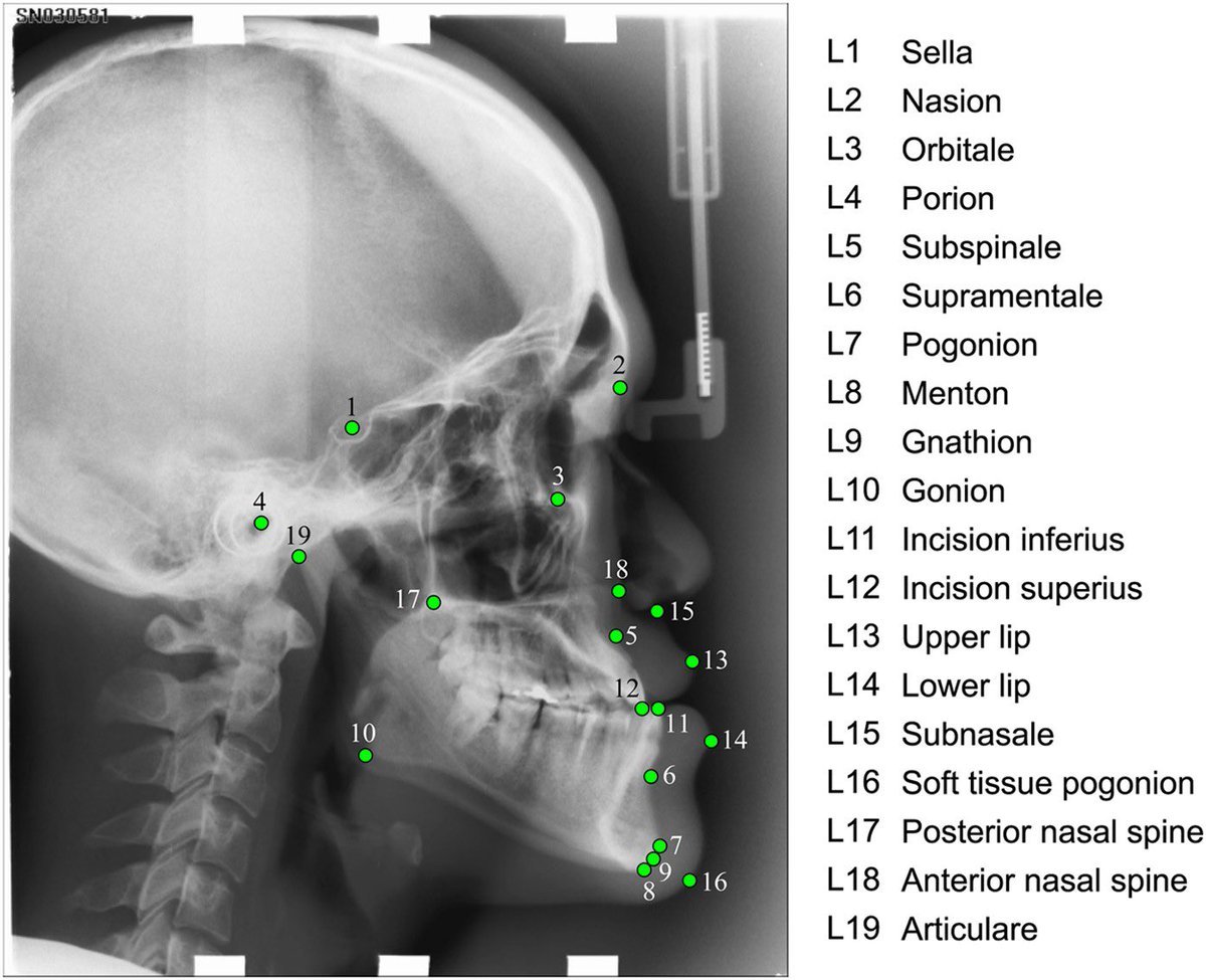 Cephalometric Analysis ✨