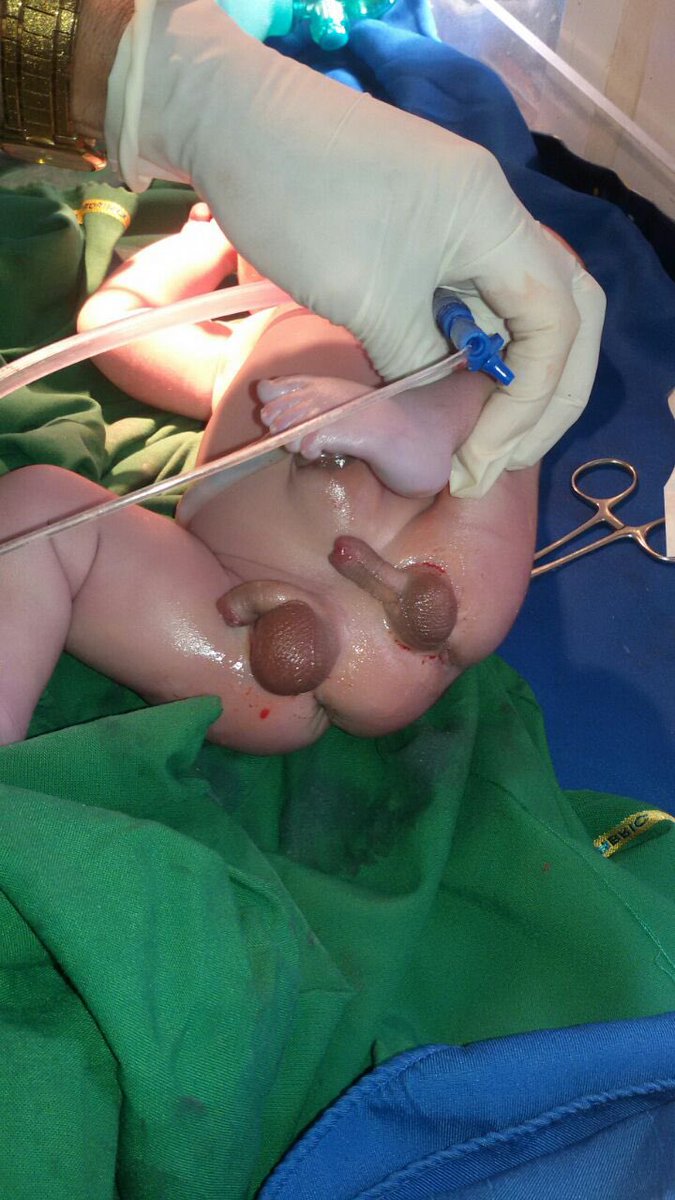 RaissaKassire's tweet image. Pauvre bébé, il est née au Tchad 🇹🇩 avec 2 organes.Prions afin que Dieu lui facilite la tâche,bon courage à sa famille 💔