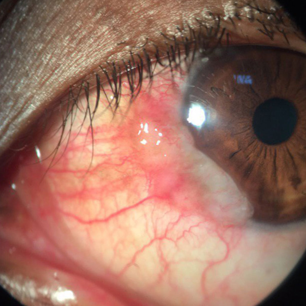 aao_ophth's tweet photo. Stay up to date with ocular surface neoplasia, #retinoblastoma and therapies for #periocular #tumors plus review challenging surgical cases. Join Academy experts on Thu., 9/14, for the webinar, The 2023 Update on #Ocular Oncology. Academy member benefit. https://t.co/0Ud3vwVFHG https://t.co/QWjsshDVWm