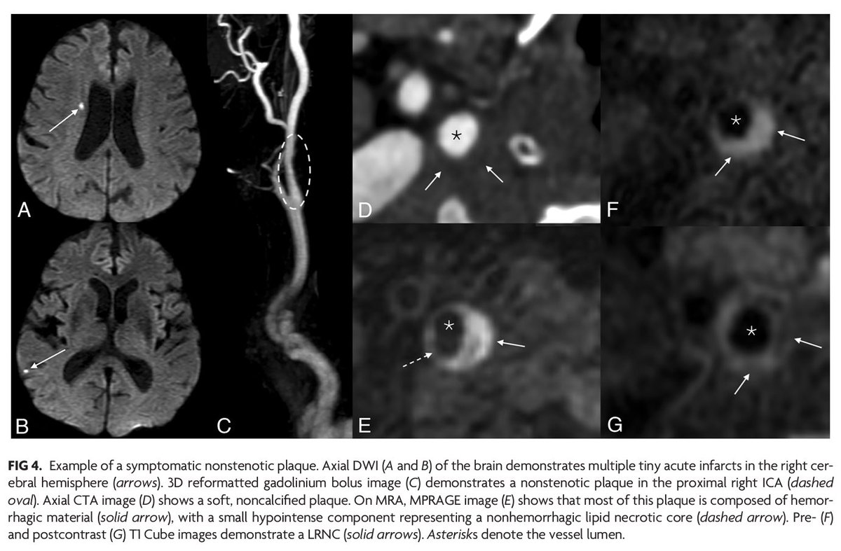 'MR Imaging of Carotid Artery Atherosclerosis: Updated Evidence on High-Risk Plaque Features and Emerging Trends' #CarotidPlaque #FellowsJournalClub #ReviewArticle #OpenAccess | bit.ly/3DObjEL