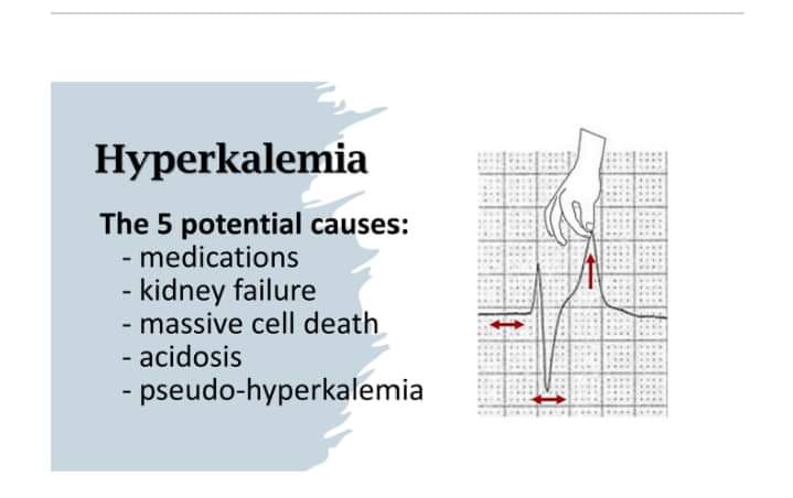 walinjom's tweet photo. Hyperkalemia on ECG. https://t.co/e0CeB2v13f