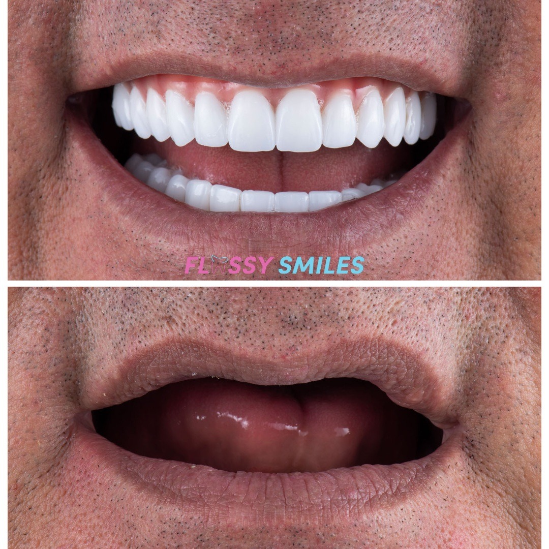 Teeth in a Day #24hours
Patient came in without any teeth and unable to eat. Dr. Gio performed an #allonfour surgery and patient was smiling the next day!

#implantsurgery #dentalimplants #allonx