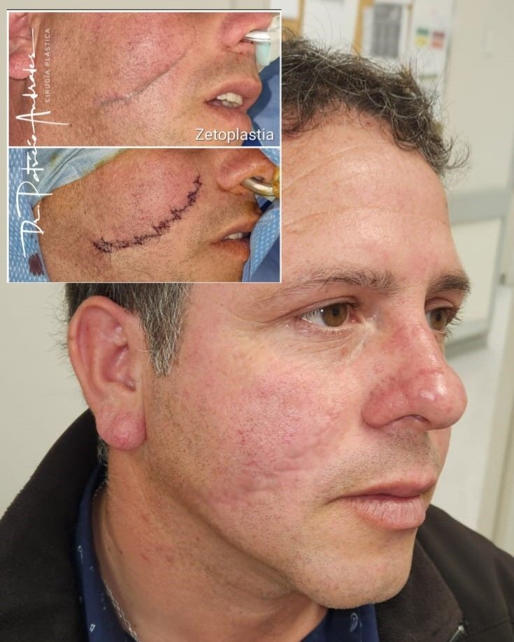 Recuerdan este caso???
Ocho meses post zetoplastia de cicatriz facial...
Esto sumado al cuidado de cicatrices con sistema elasto-compresivo y bloqueador solar logra excelentes resultados
.
Para más información visita patricioandrades.cl o llámanos al +569 51993148