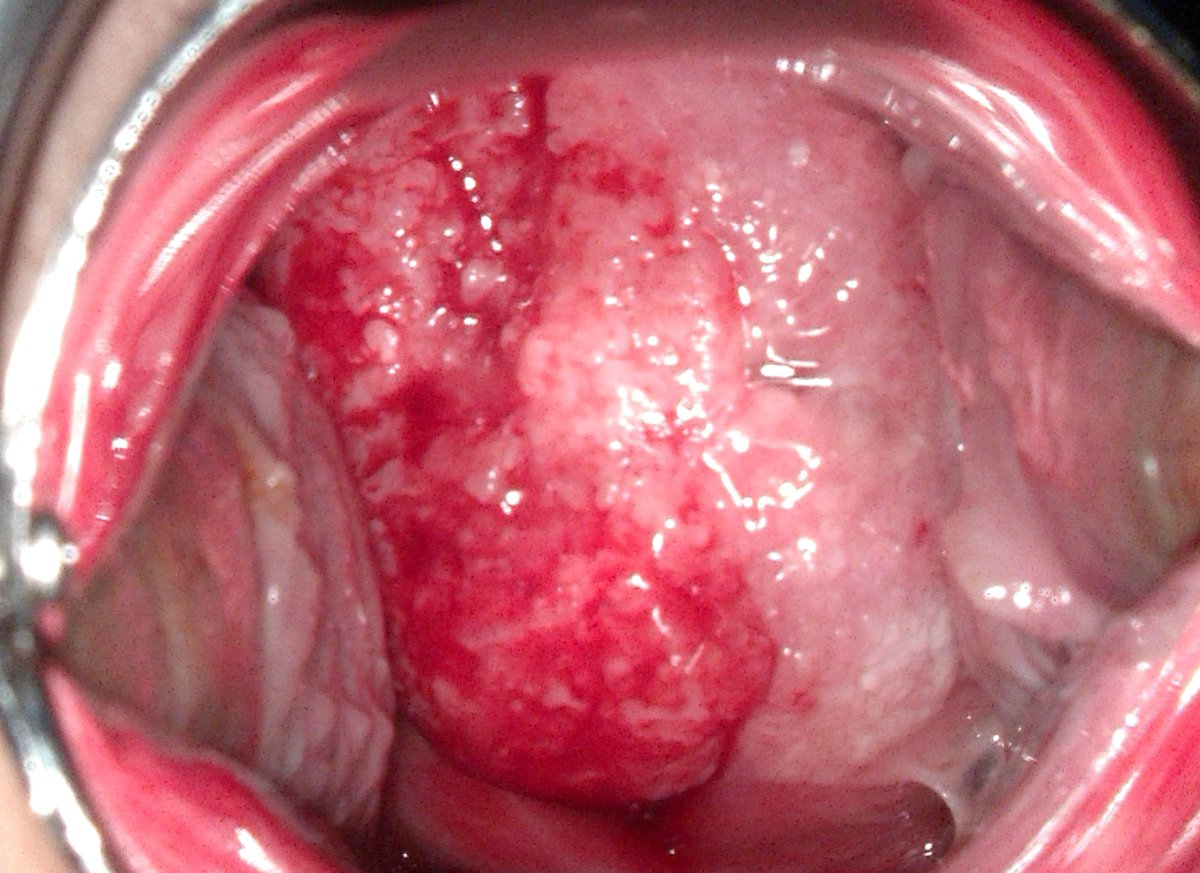 CEOGjournal's tweet photo. #Neoadjuvant_chemotherapy with quick #cisplatin-VP 16 followed by robotic radical #trachelectomy in FIGO 2018 stage 1B2 #cervical_cancer
has been published in @CEOGjournal at https://t.co/CGc3h9JJae
Welcome to read it!
#Cervical_cancer #Fertility_sparing_treatment https://t.co/OQ06rJr2IR