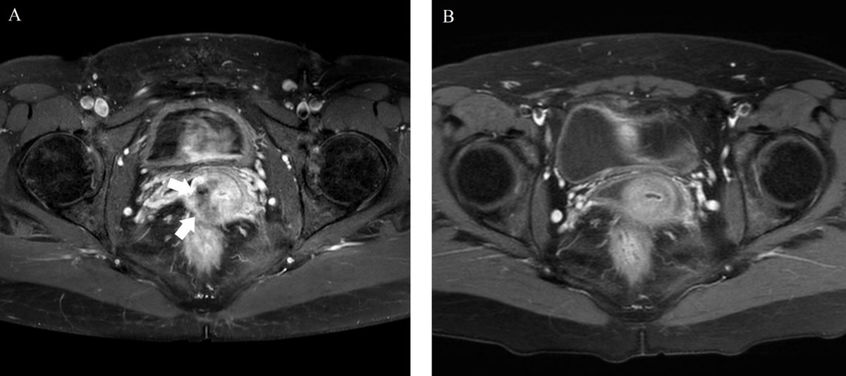 CEOGjournal's tweet photo. #Neoadjuvant_chemotherapy with quick #cisplatin-VP 16 followed by robotic radical #trachelectomy in FIGO 2018 stage 1B2 #cervical_cancer
has been published in @CEOGjournal at https://t.co/CGc3h9JJae
Welcome to read it!
#Cervical_cancer #Fertility_sparing_treatment https://t.co/OQ06rJr2IR